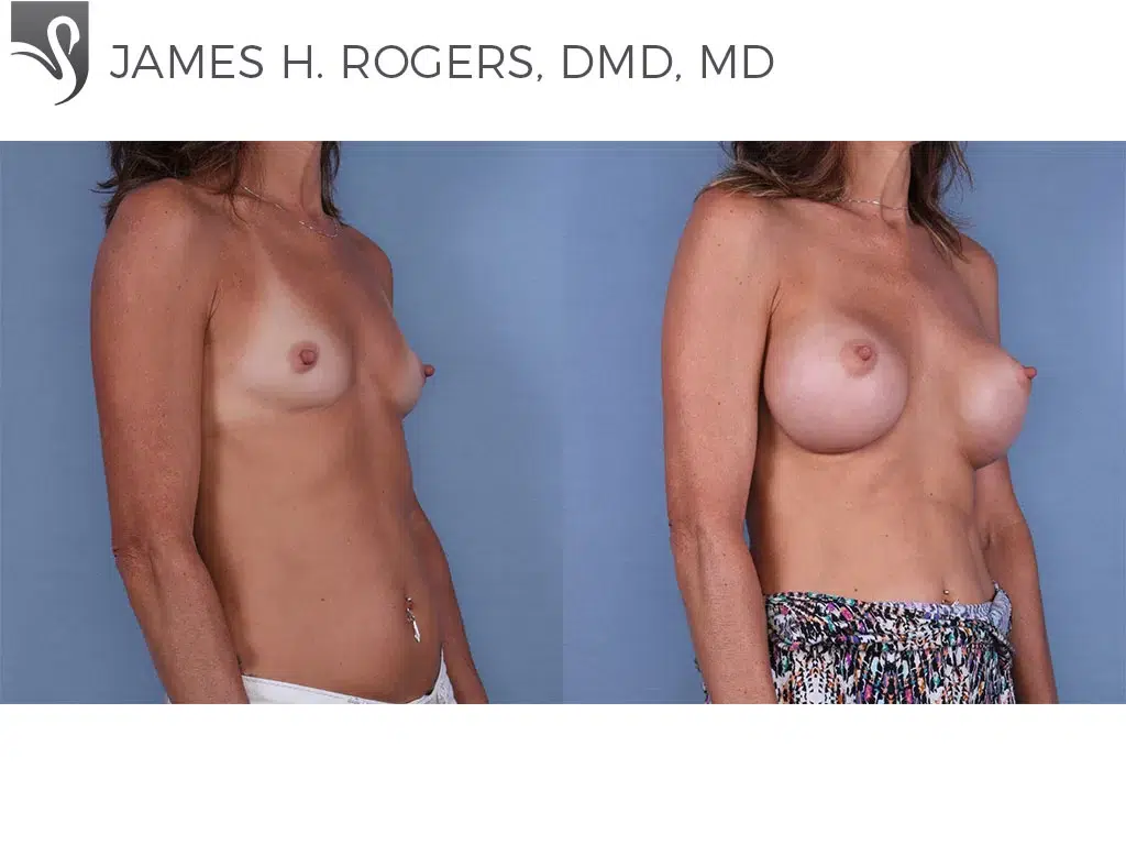 Before and After Image: Breast Augmentation Case #63809 - right-front-oblique
