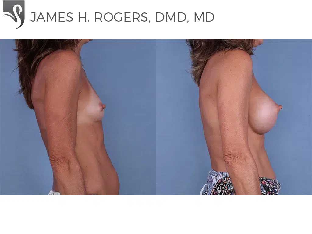 Before and After Image: Breast Augmentation Case #63809 - right-side