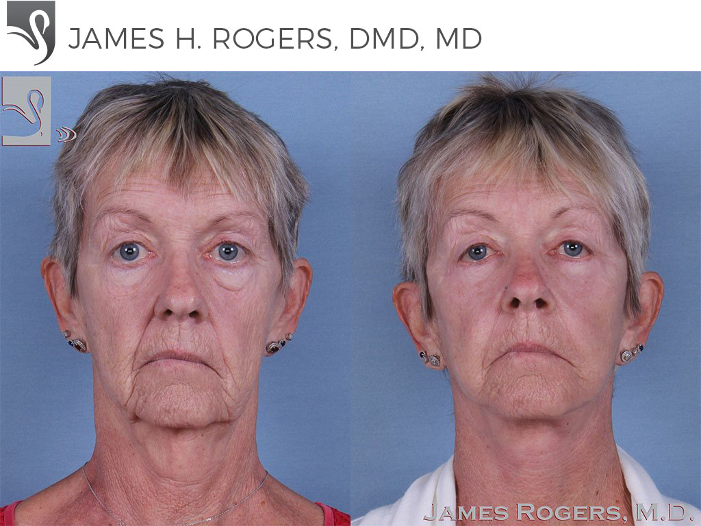 Before and After Image: Face Lift Case #63831 - front