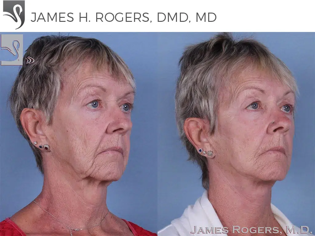 Before and After Image: Face Lift Case #63831 - right-front-oblique
