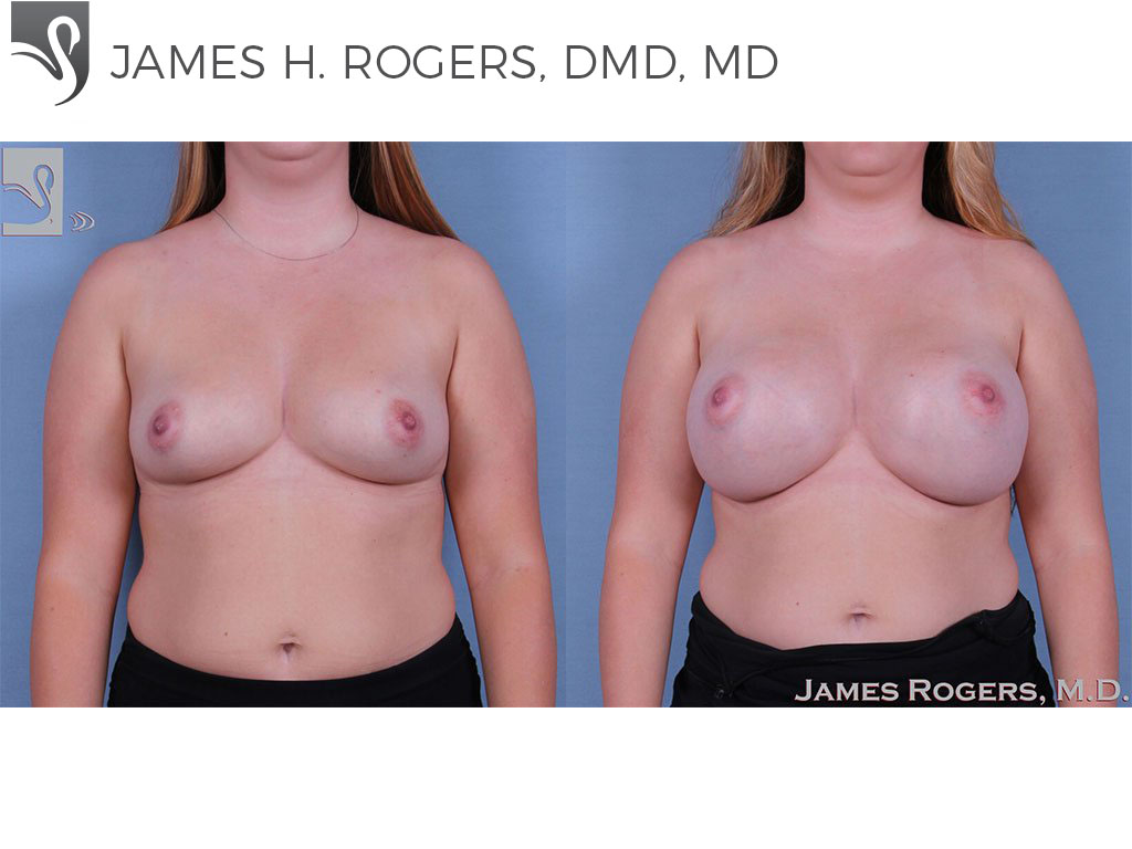 Before and After Image: Breast Augmentation Case #63850 - front
