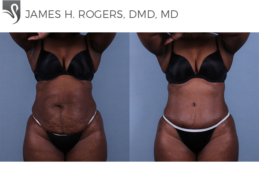 Before and After Image: Abdominoplasty (Tummy Tuck) Case #6395 - front
