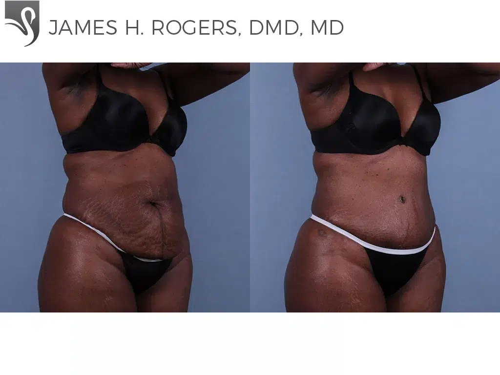 Before and After Image: Abdominoplasty (Tummy Tuck) Case #6395 - right-front-oblique