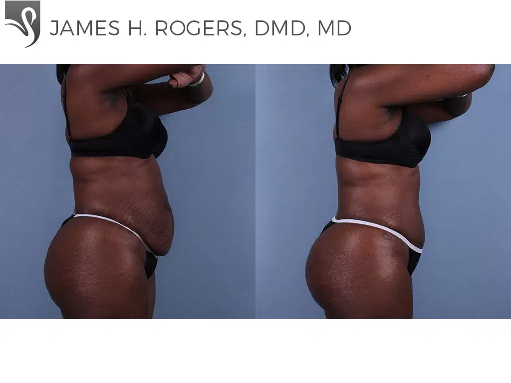 Before and After Image: Abdominoplasty (Tummy Tuck) Case #6395 - right-side