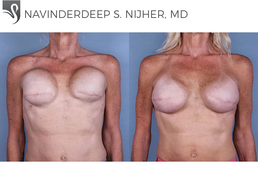 Before and After Image: Breast Reconstruction Case #63952 - front