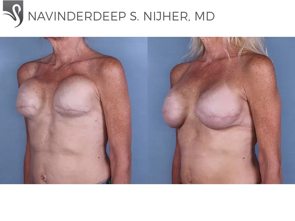 Before and After Image: Breast Reconstruction Case #63952 - left-front-oblique