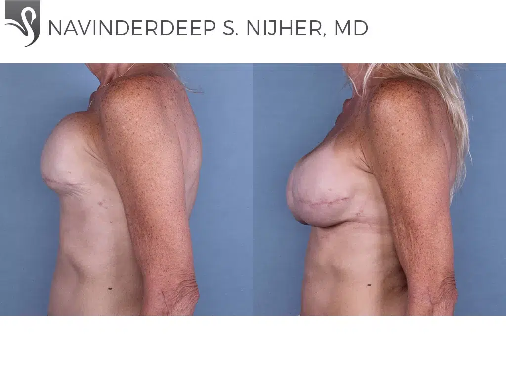 Before and After Image: Breast Reconstruction Case #63952 - left-side