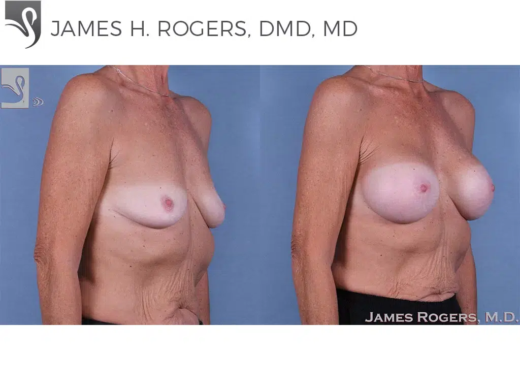 Before and After Image: Breast Augmentation Case #63977 - right-front-oblique