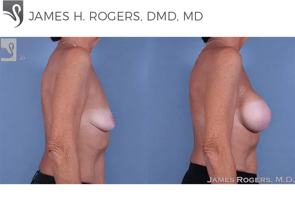 Before and After Image: Breast Augmentation Case #63977 - right-side