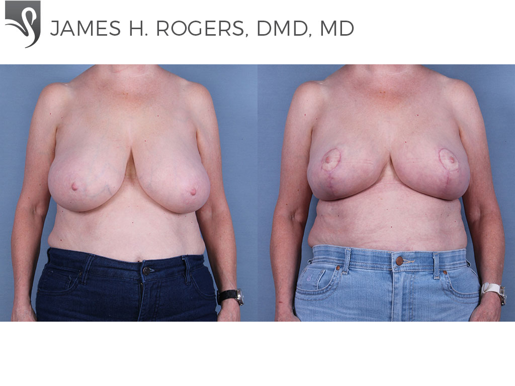 Before and After Image: Female Breast Reduction Case #64102 - front