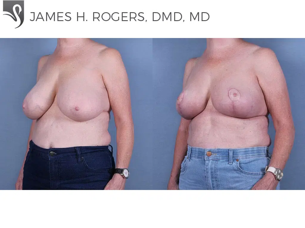 Before and After Image: Female Breast Reduction Case #64102 - left-front-oblique