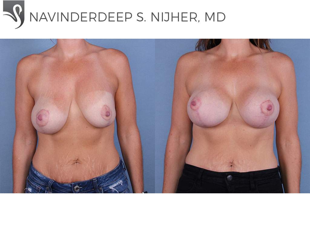Before and After Image: Breast Revisions Case #64103 - front