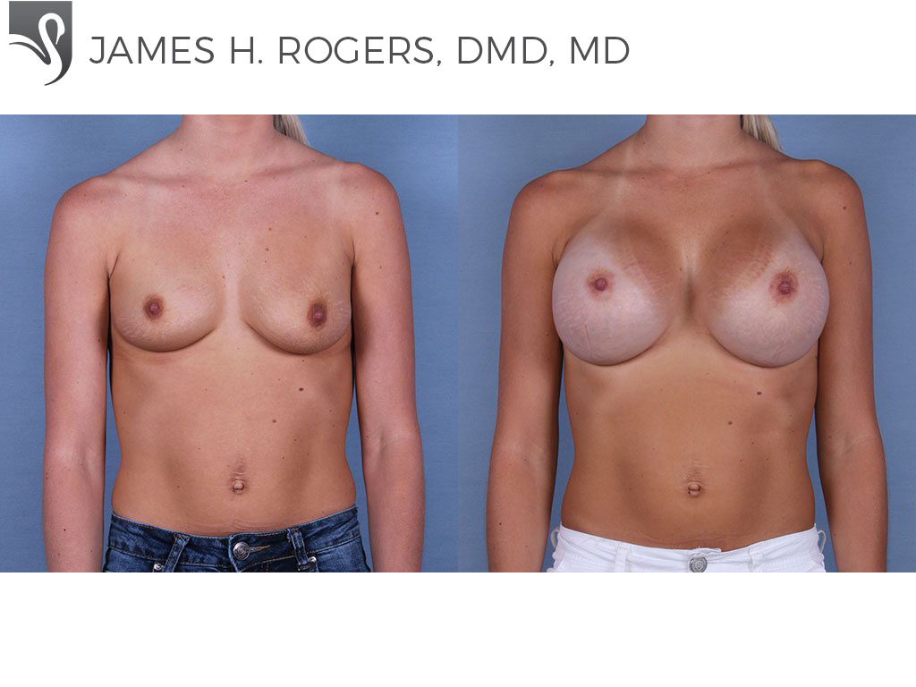 Before and After Image: Breast Augmentation Case #64231 - front
