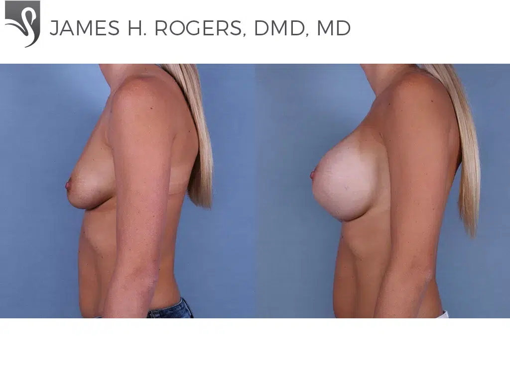 Before and After Image: Breast Augmentation Case #64231 - left-side