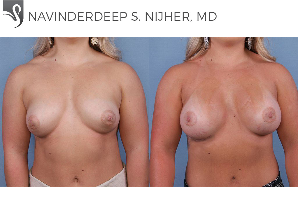 Before and After Image: Breast Augmentation Case #64357 - front