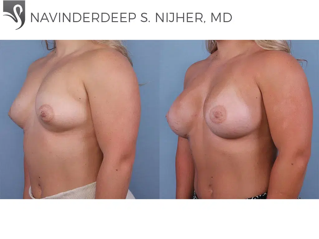 Before and After Image: Breast Augmentation Case #64357 - left-front-oblique