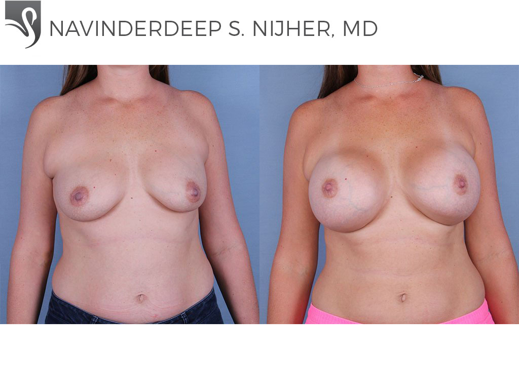 Before and After Image: Breast Augmentation Case #64470 - front