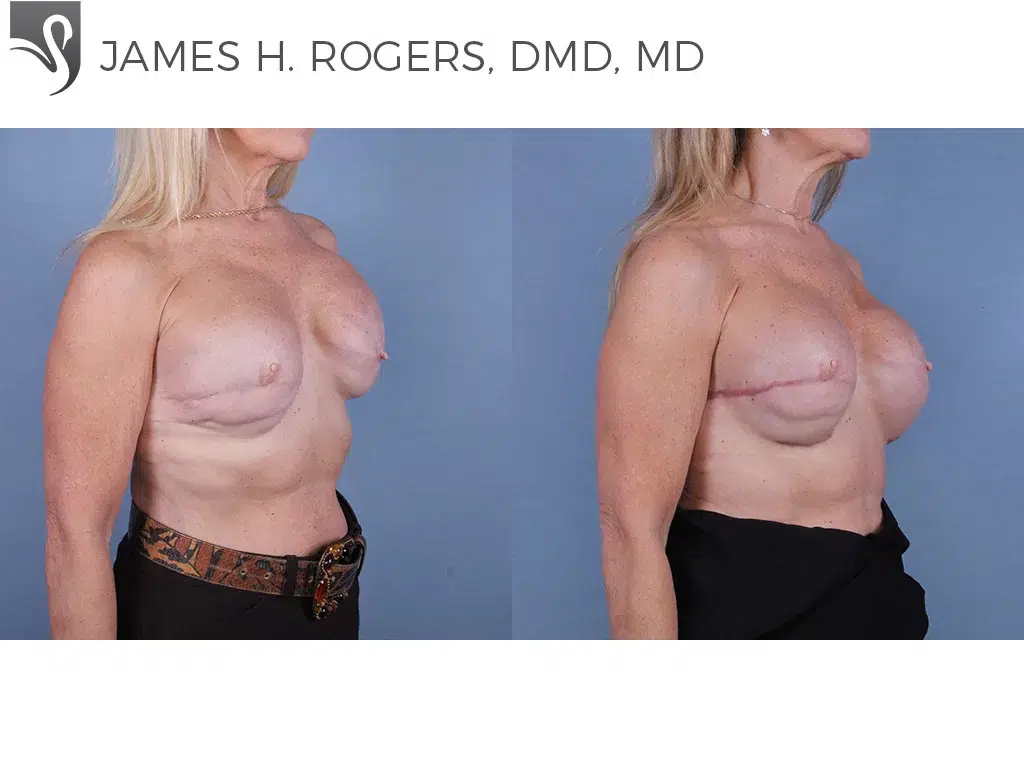 Before and After Image: Breast Reconstruction Case #64488 - right-front-oblique