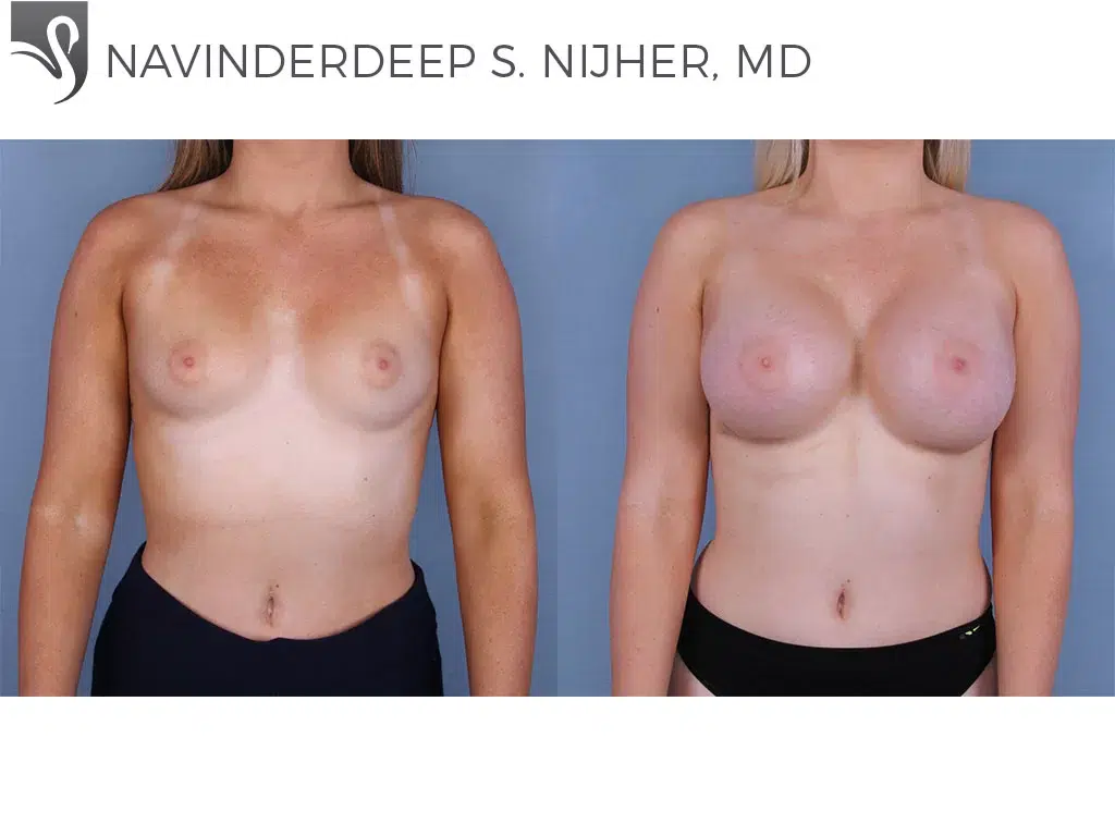 Before and After Image: Breast Augmentation Case #64565 - front