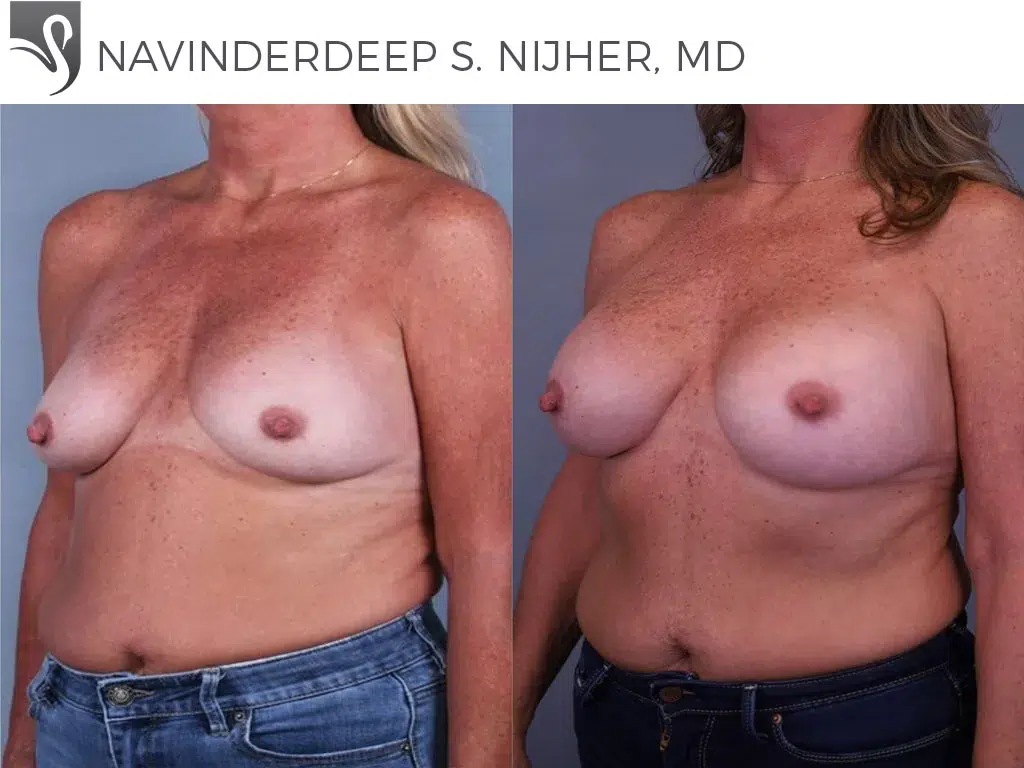 Before and After Image: Breast Augmentation Case #64612 - left-front-oblique