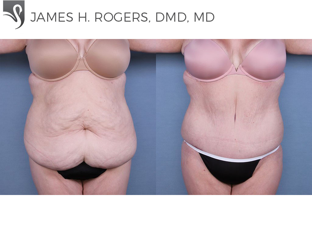 Before and After Image: Abdominoplasty (Tummy Tuck) Case #64862 - front