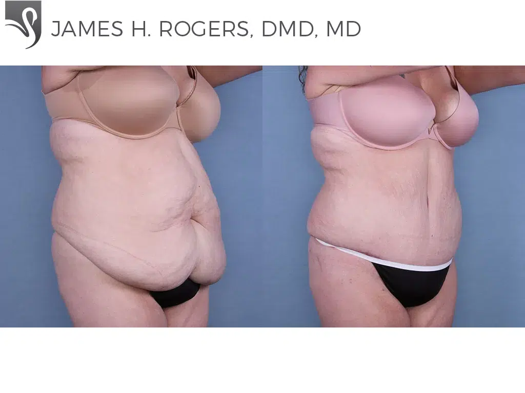 Before and After Image: Abdominoplasty (Tummy Tuck) Case #64862 - right-front-oblique