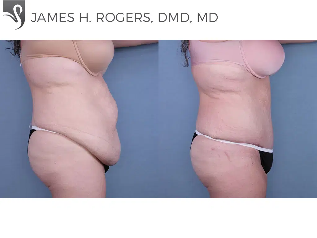 Before and After Image: Abdominoplasty (Tummy Tuck) Case #64862 - right-side