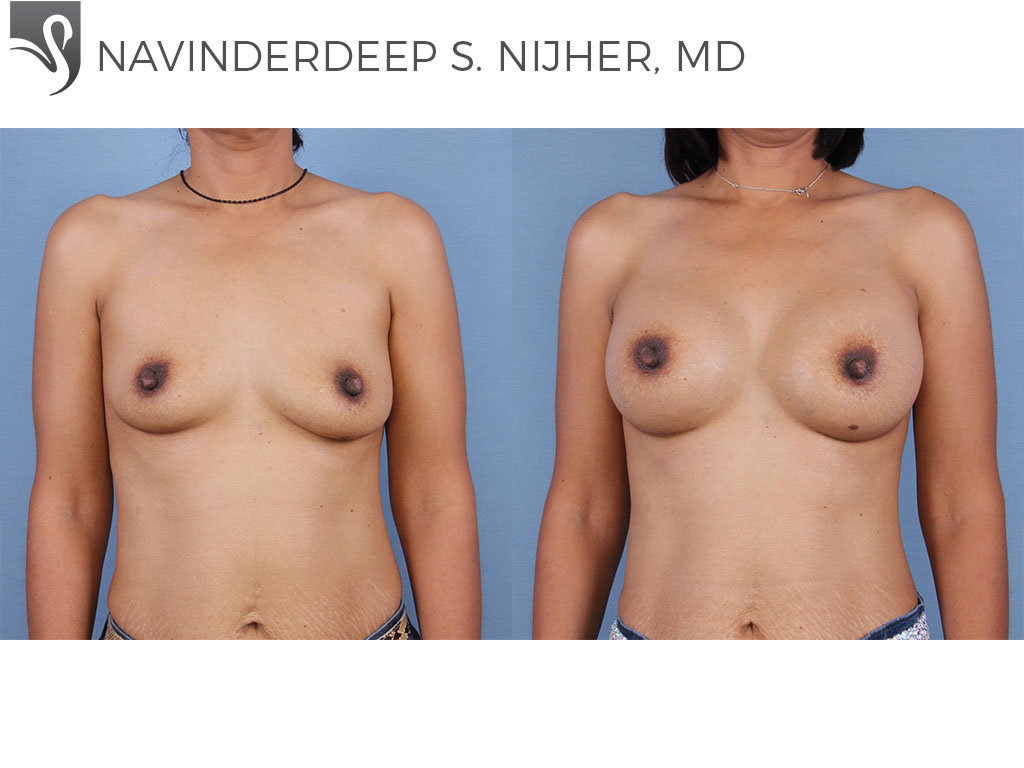 Before and After Image: Breast Augmentation Case #64872 - front