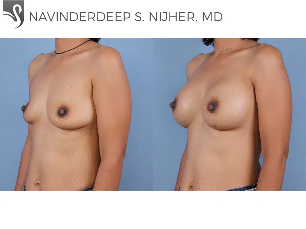 Before and After Image: Breast Augmentation Case #64872 - left-front-oblique