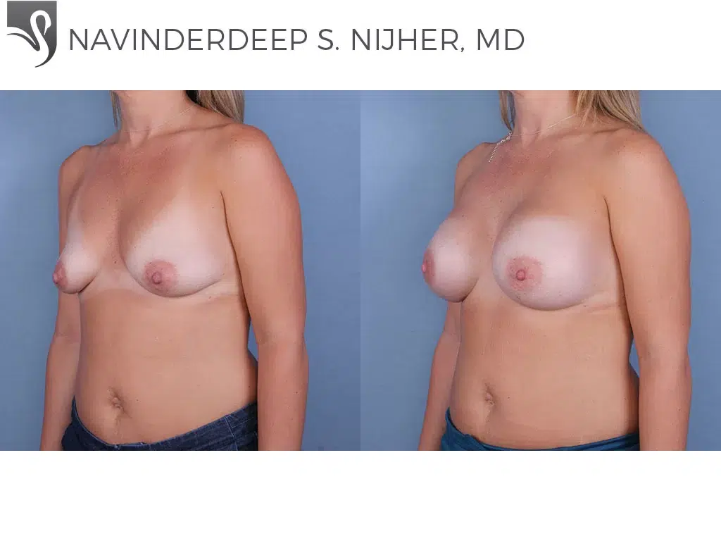 Before and After Image: Breast Augmentation Case #64909 - left-front-oblique
