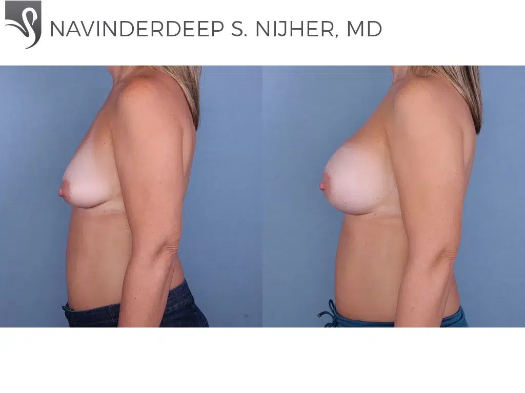 Before and After Image: Breast Augmentation Case #64909 - left-side