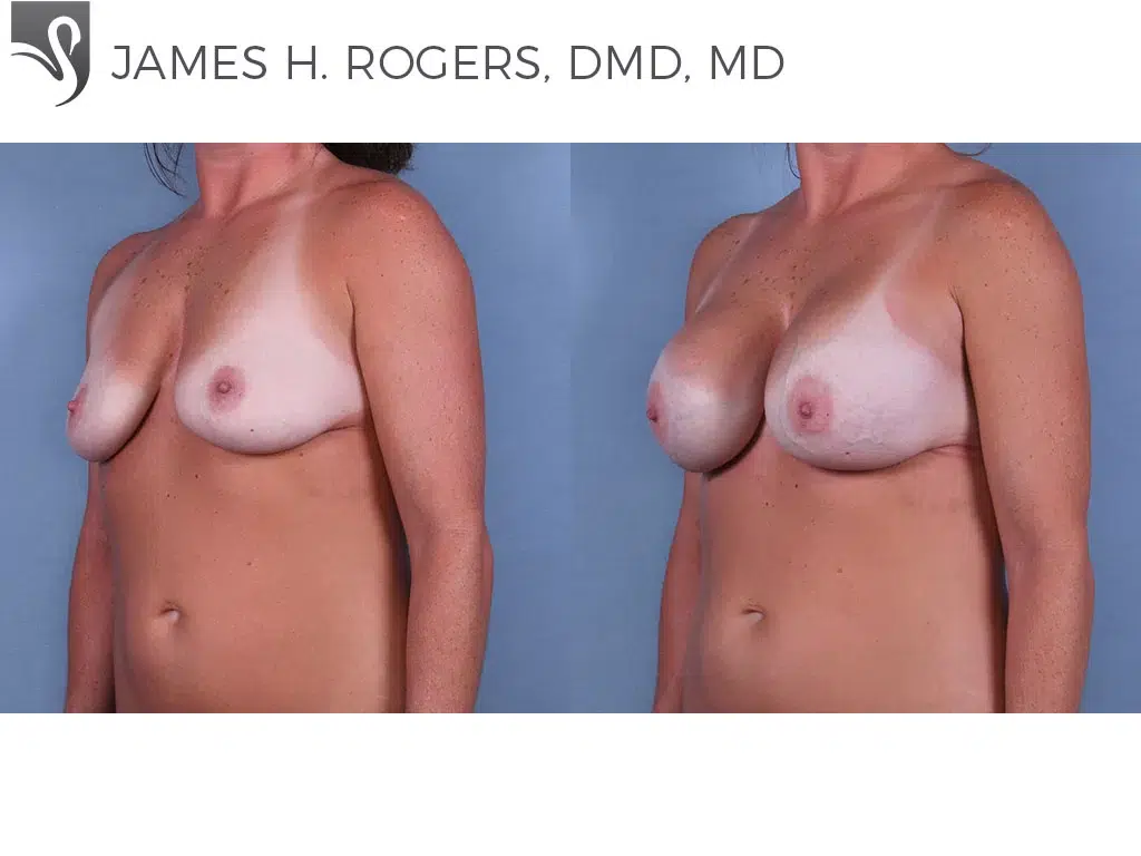 Before and After Image: Breast Augmentation Case #64936 - left-front-oblique