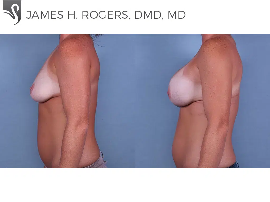 Before and After Image: Breast Augmentation Case #64936 - left-side