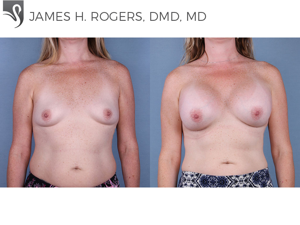 Before and After Image: Breast Augmentation Case #65007 - front