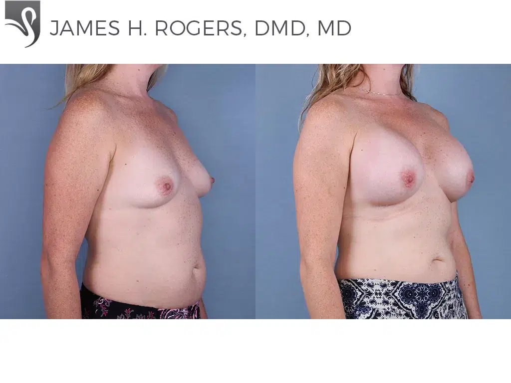 Before and After Image: Breast Augmentation Case #65007 - right-front-oblique