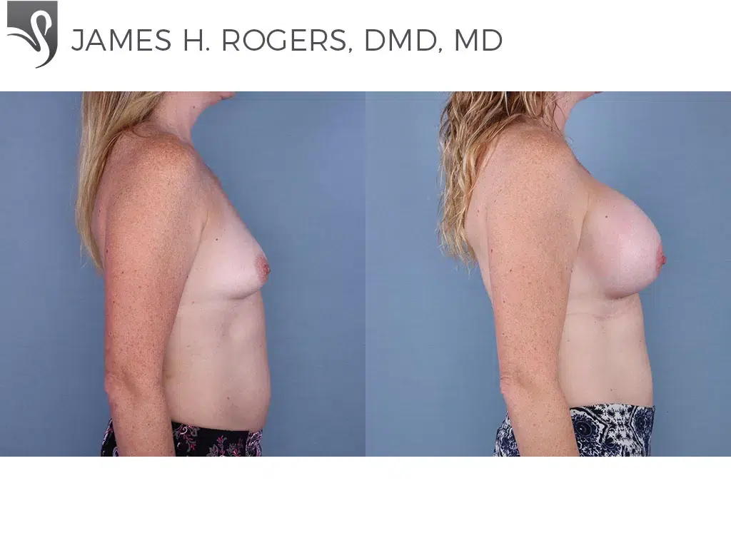 Before and After Image: Breast Augmentation Case #65007 - right-side