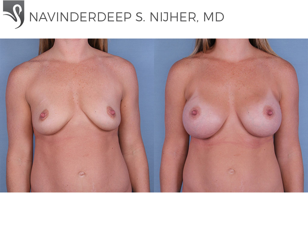 Before and After Image: Breast Augmentation Case #65075 - front