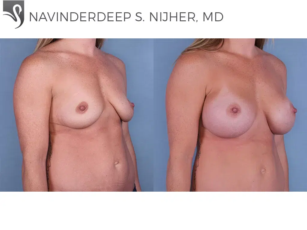 Before and After Image: Breast Augmentation Case #65075 - right-front-oblique