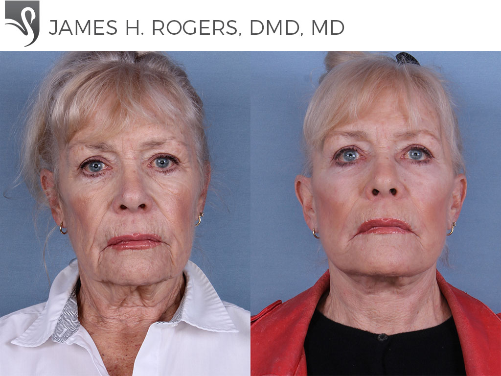 Before and After Image: Face Lift Case #65150 - front