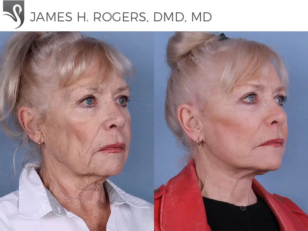 Before and After Image: Face Lift Case #65150 - right-front-oblique