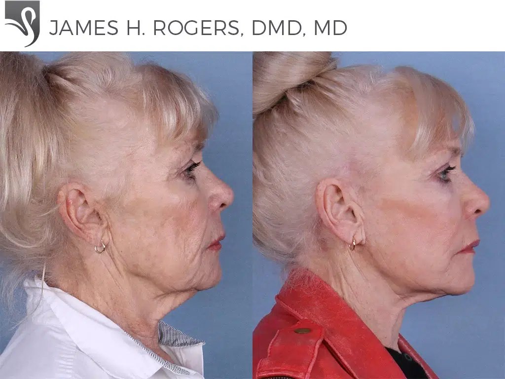 Before and After Image: Face Lift Case #65150 - right-side