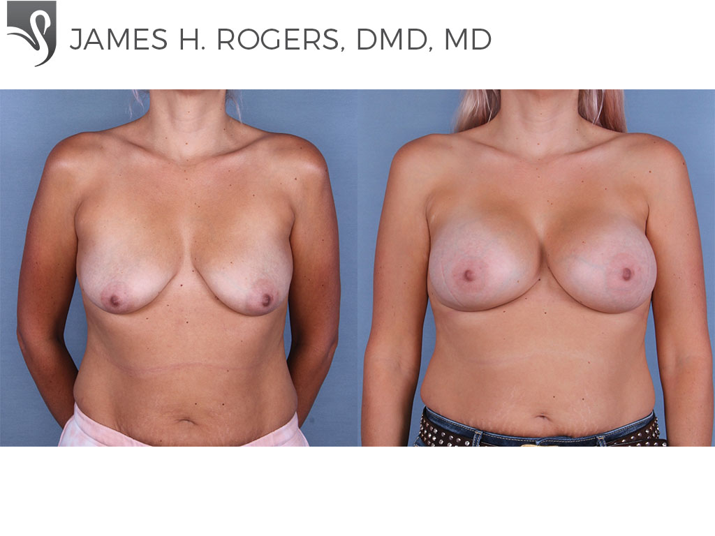 Before and After Image: Breast Augmentation Case #65156 - front