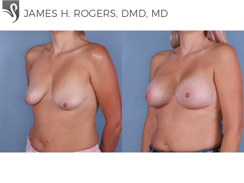 Before and After Image: Breast Augmentation Case #65156 - left-front-oblique