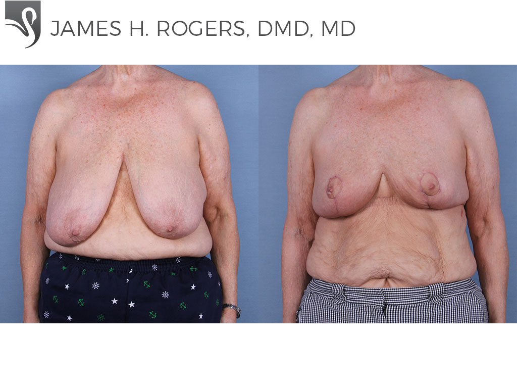 Before and After Image: Female Breast Reduction Case #65229 - front