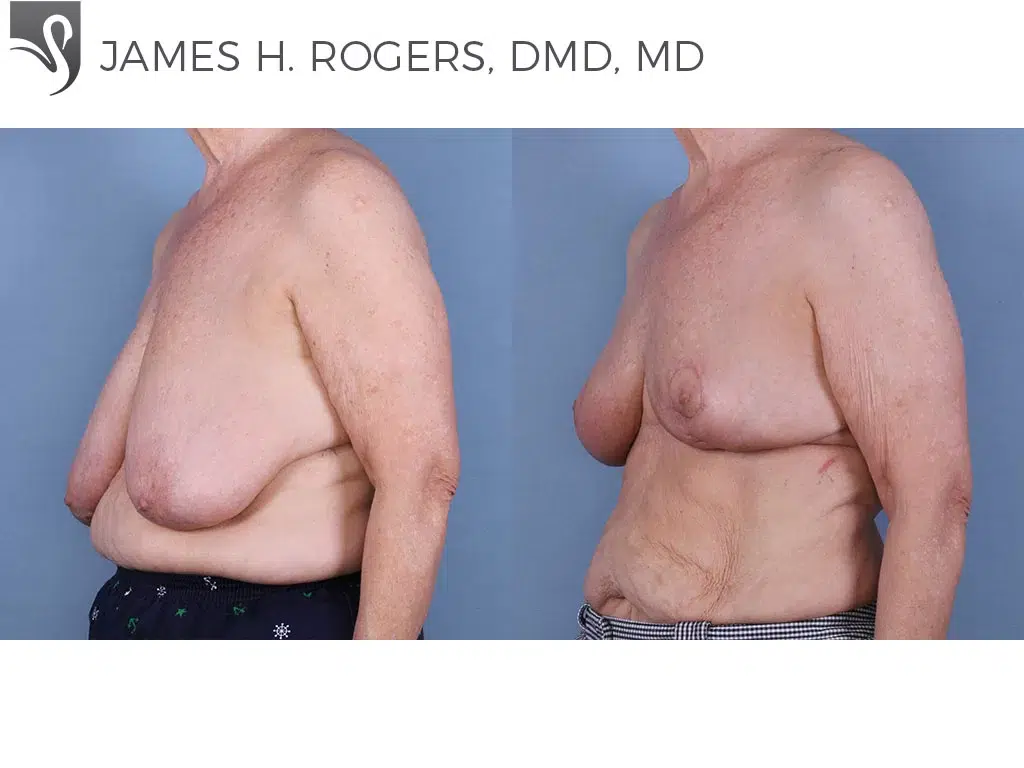 Before and After Image: Female Breast Reduction Case #65229 - left-front-oblique