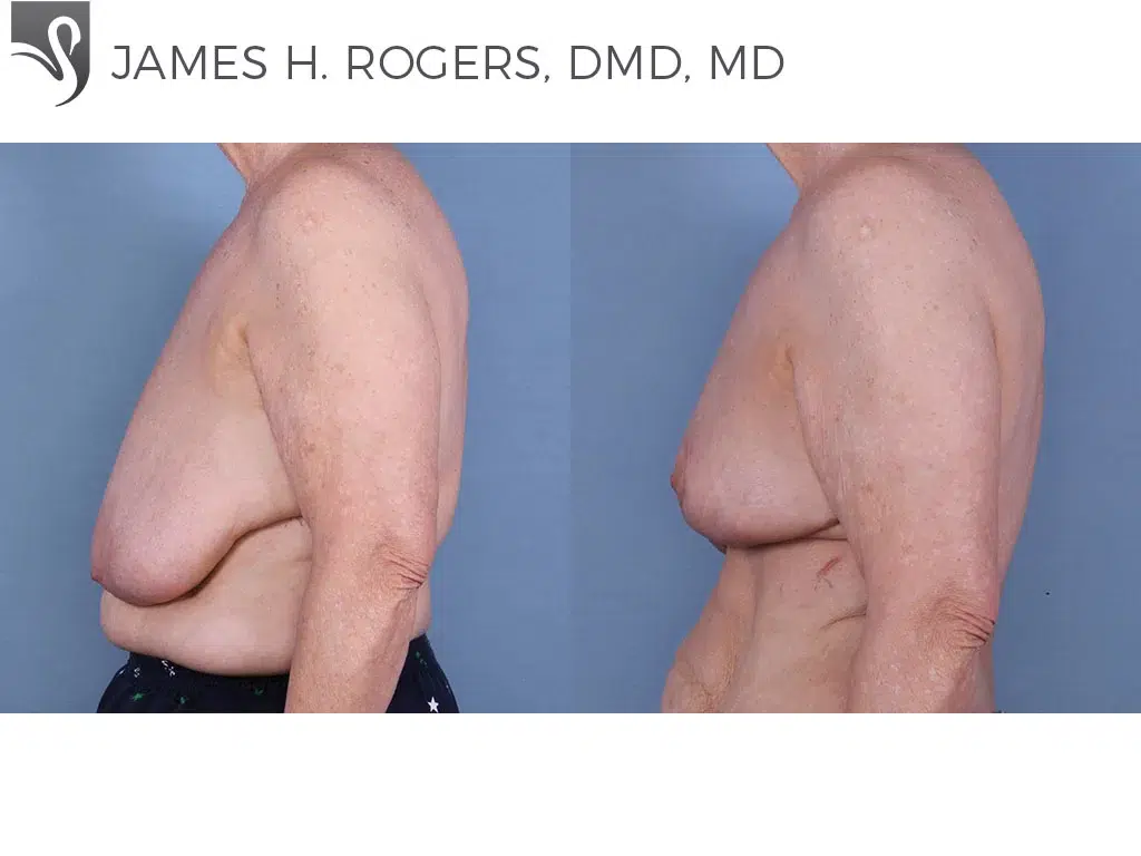 Before and After Image: Female Breast Reduction Case #65229 - left-side