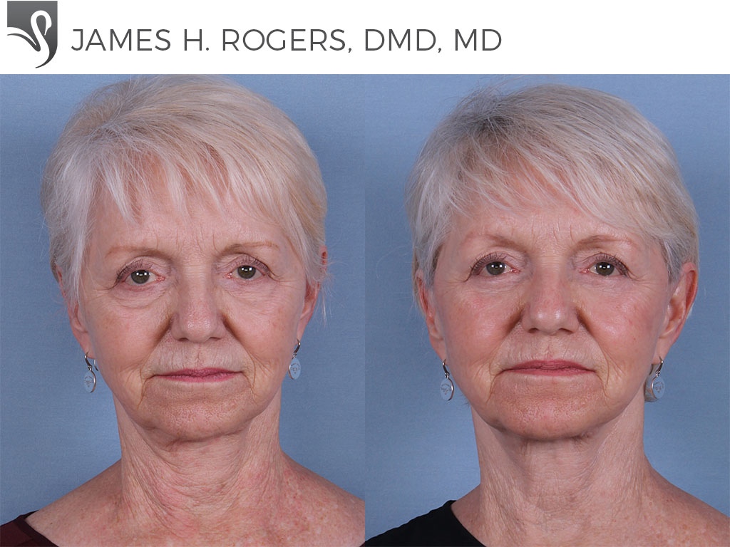 Before and After Image: Face Lift Case #65376