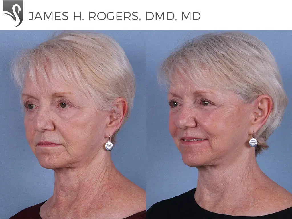 Before and After Image: Face Lift Case #65376 - left-front-oblique