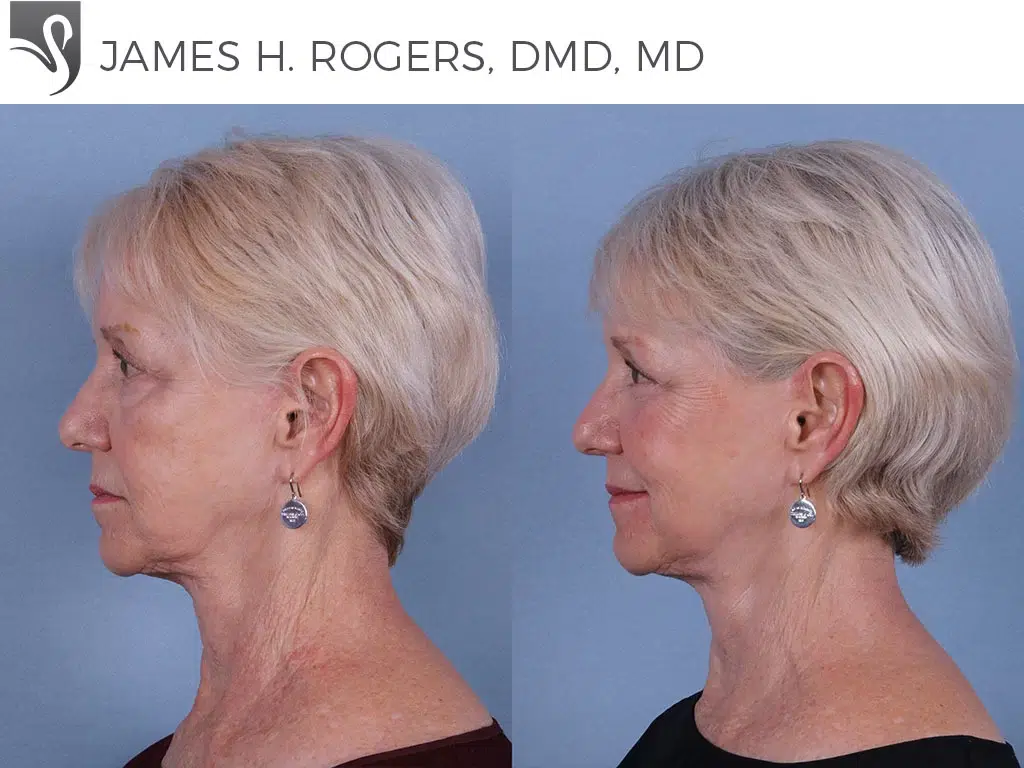 Before and After Image: Face Lift Case #65376 - left-side