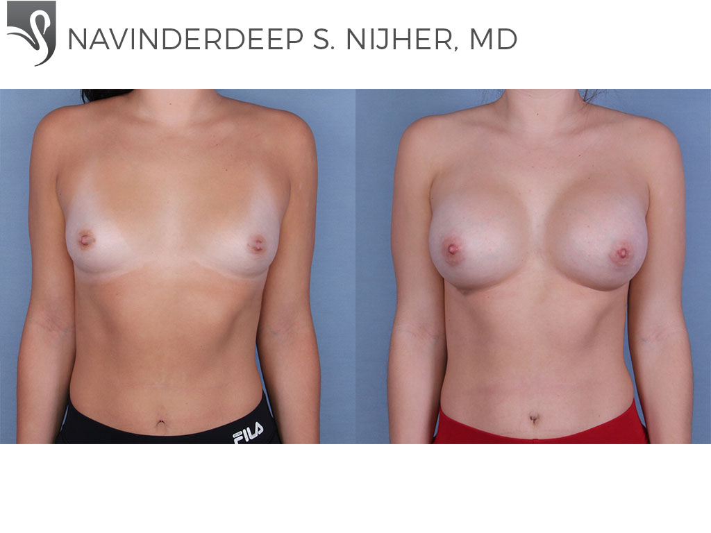 Before and After Image: Breast Augmentation Case #65379 - front